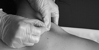 Axon centro de fisioterapia en Irún. Tratamiento manual punción seca